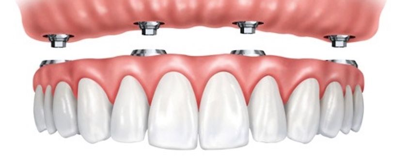 mini implants