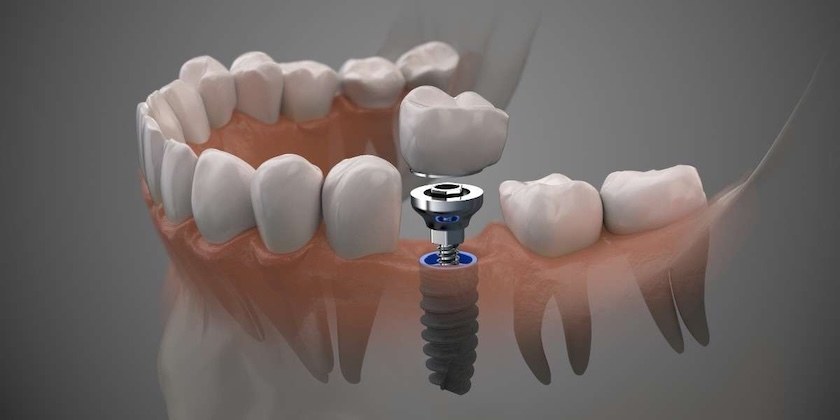 dental implants