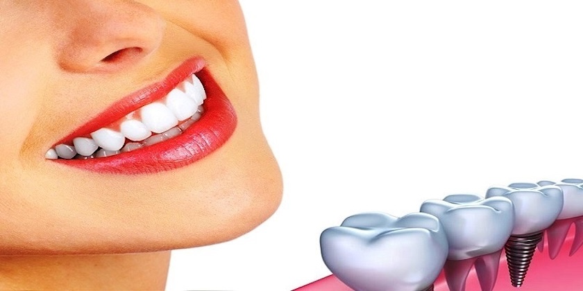 dental implants
